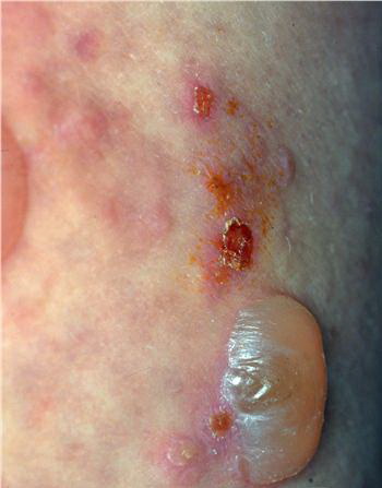 Bullous Pemphigoid Pictures, Images & Photos | Photobucket