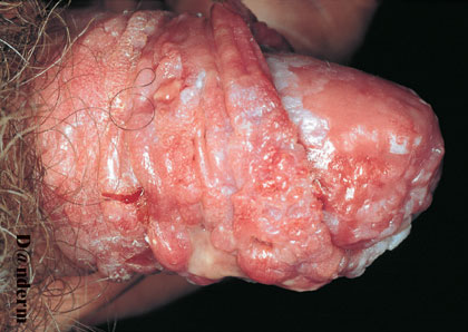 Tumor In Penis 3