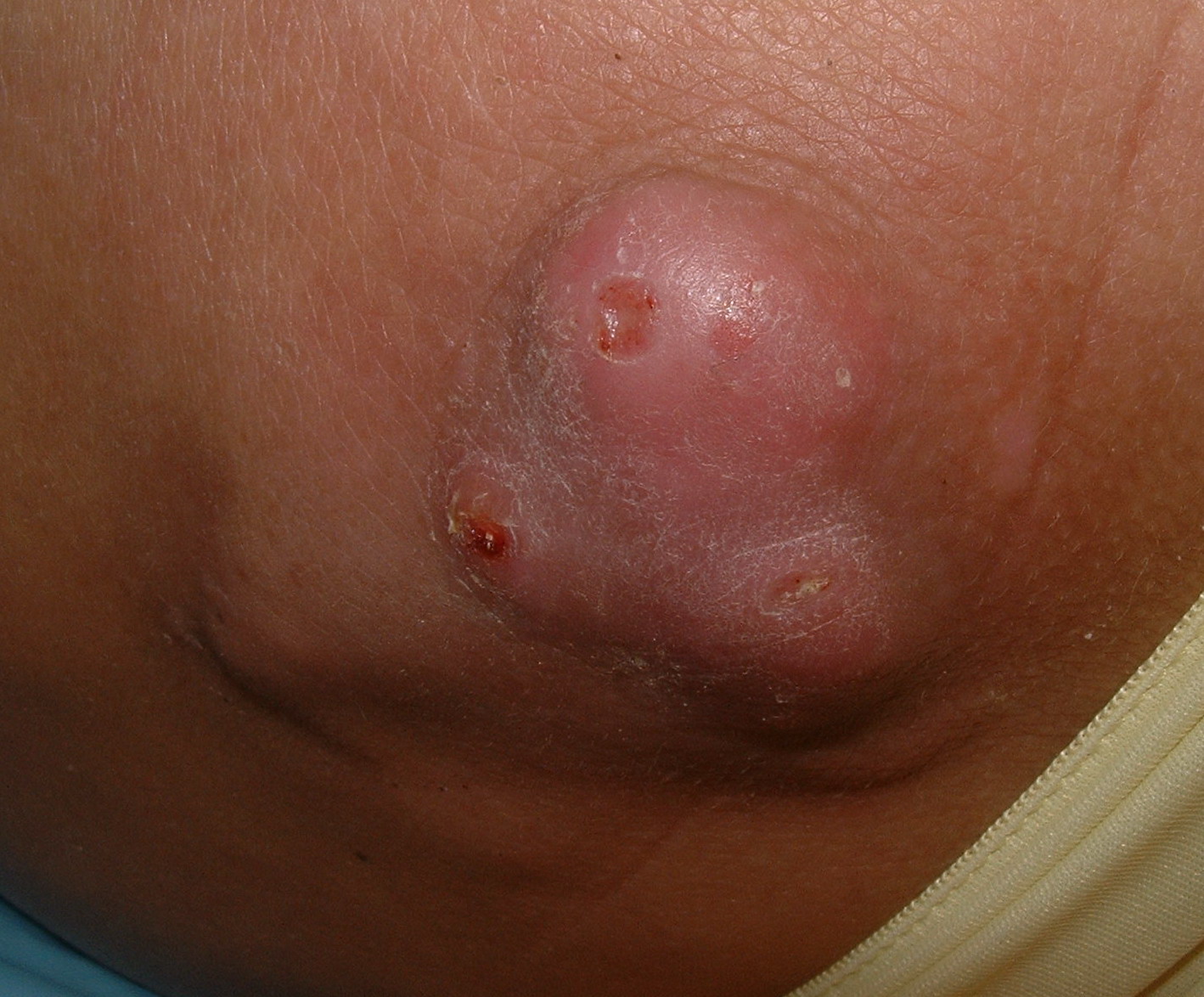 calcinosis cutis #10