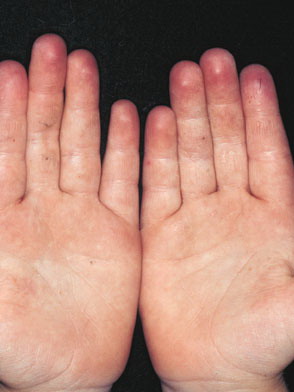 Caterpillar Rash