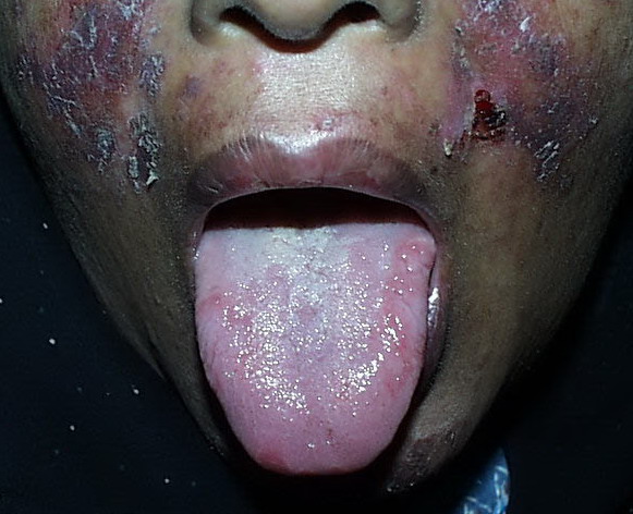 Download this What Lupus Disease... picture