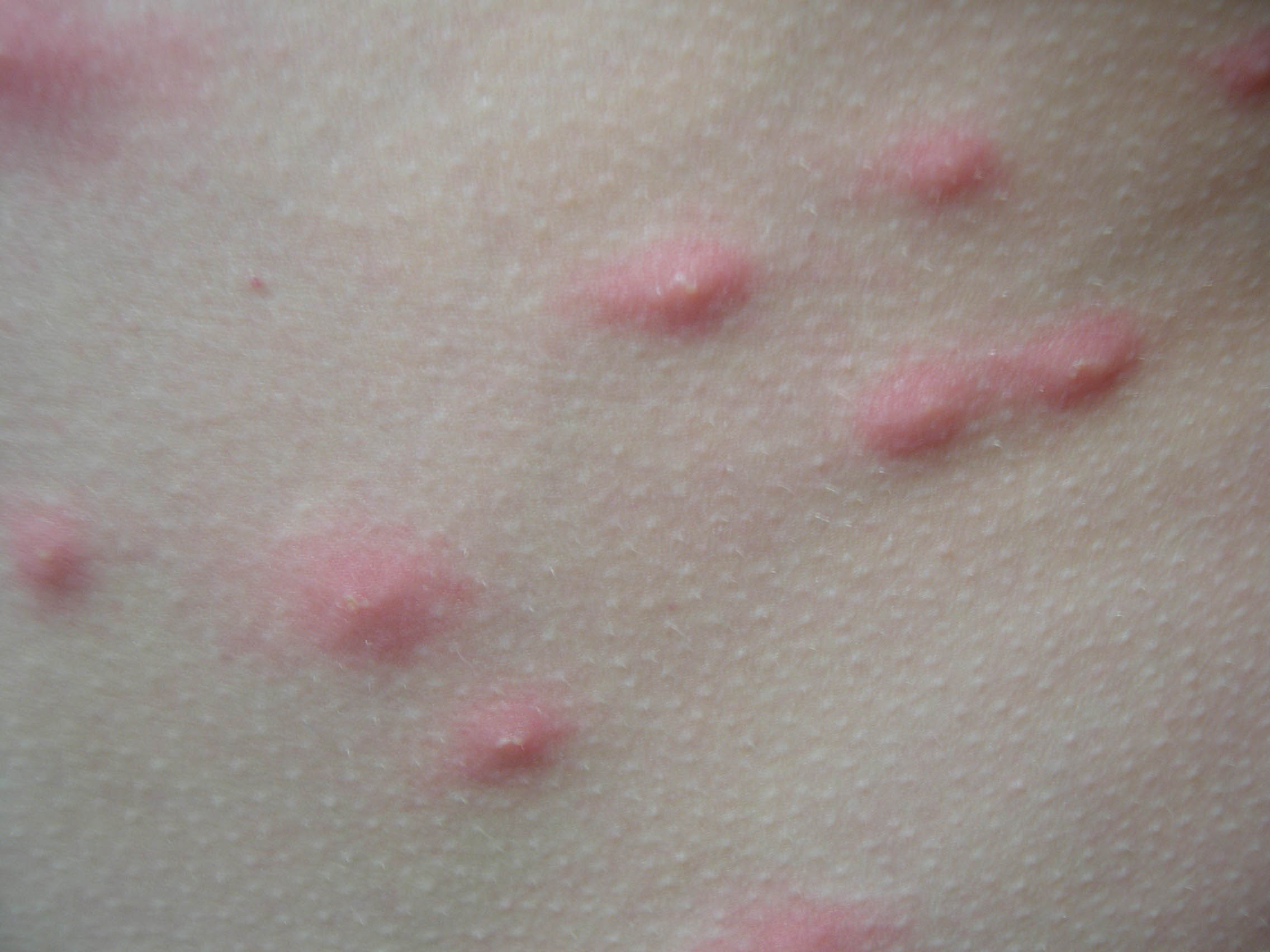 Picture of Cercarial Dermatitis: Swimmer's Itch - WebMD