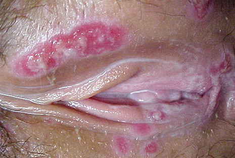 Photo Quiz: Nonhealing Vulvar Ulcer - American Family ...