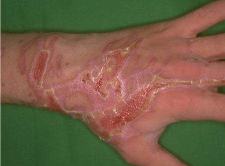 Naoh Burns