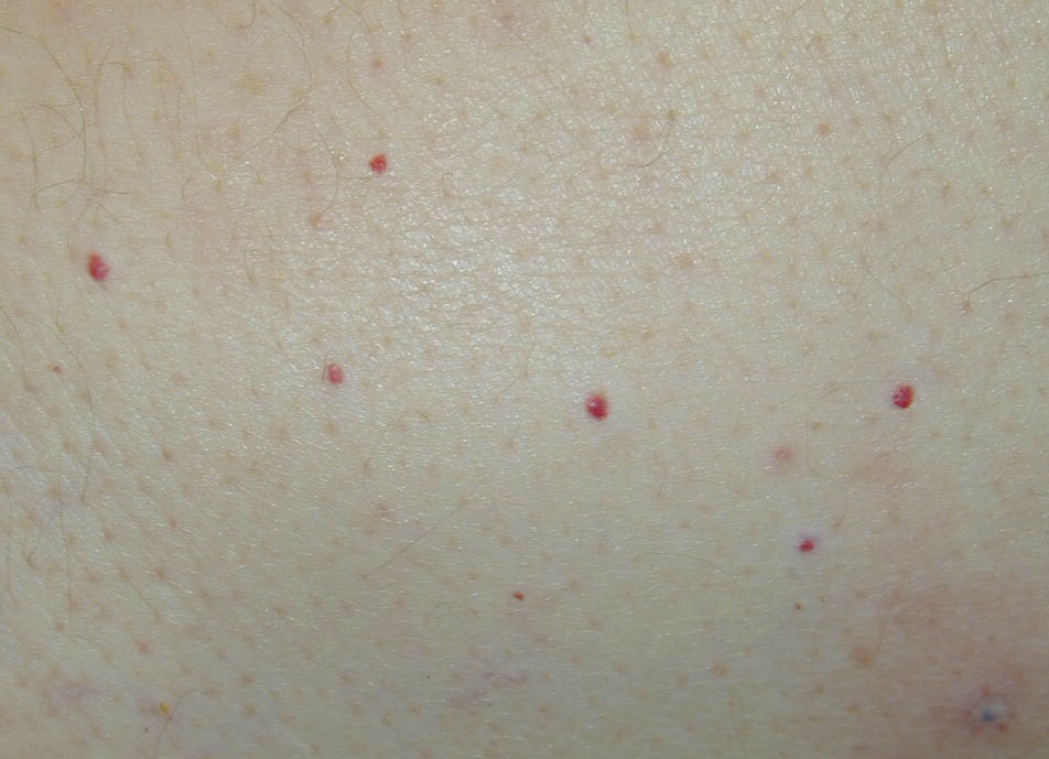 Red Spots Under Skin On Arms And Legs 07