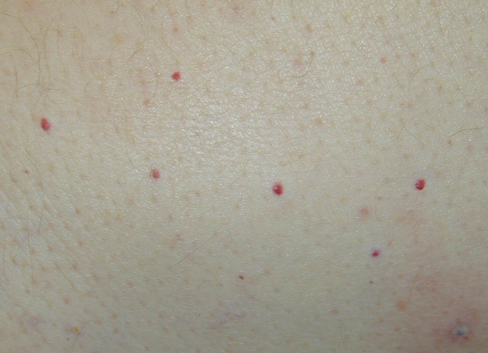 Gallery For Pinpoint Red Dots On Skin