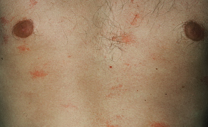 Cholinergic Urticaria: Background, Etiology, Epidemiology