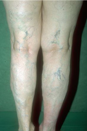 Venous insufficiency : MedlinePlus Medical Encyclopedia