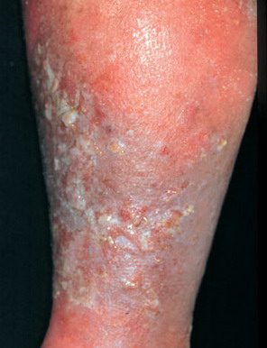 Varicose Eczema. Dermatitis and exzema treatment, causes.