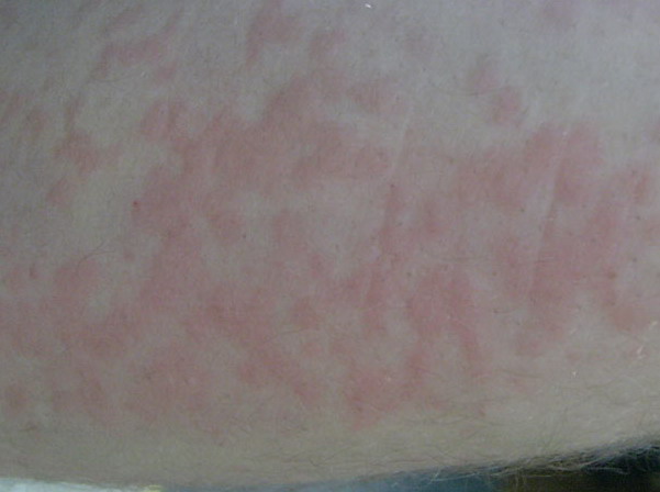 Urticaria, Cold - WebMD