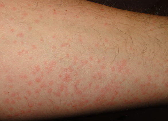 Hives Causes, Picture, & Treatment - WebMD