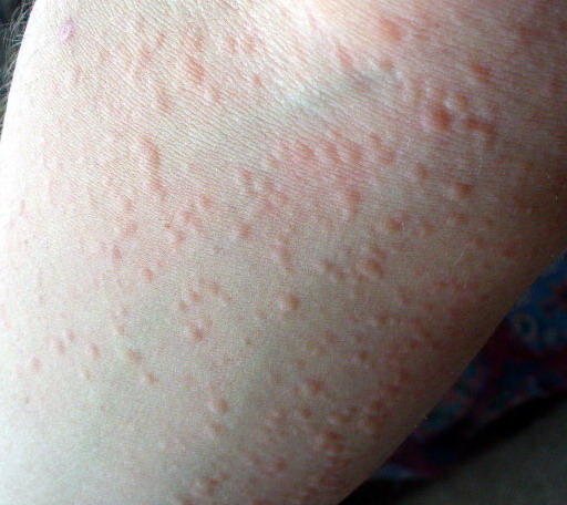 cold urticaria pictures