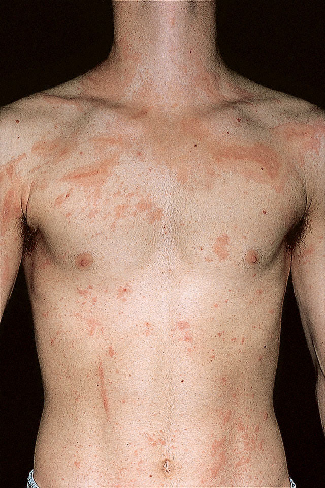 Pityriasis rosea (Christmas tree rash): Causes, Treatment ...