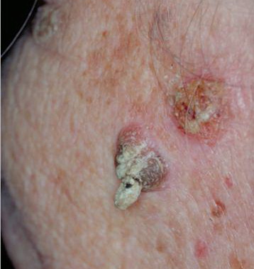 Cutaneous Horn - Skin Cancer - HealthCentral