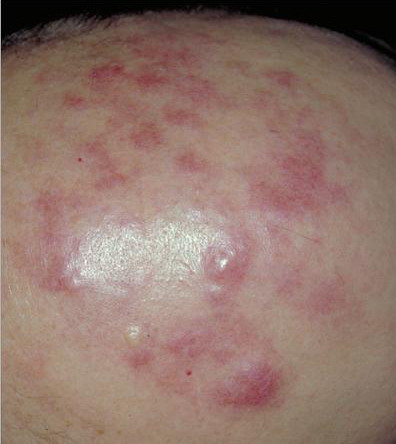 Cutaneous T cell lymphoma - Wikipedia
