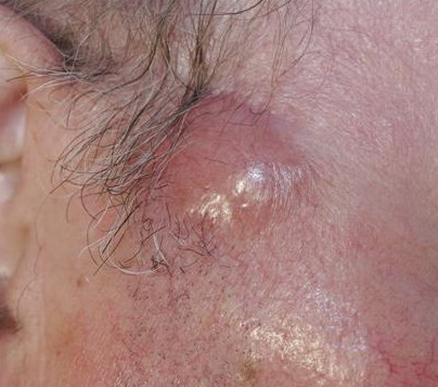 Cutaneous T -cell Lymphoma - moffitt.org