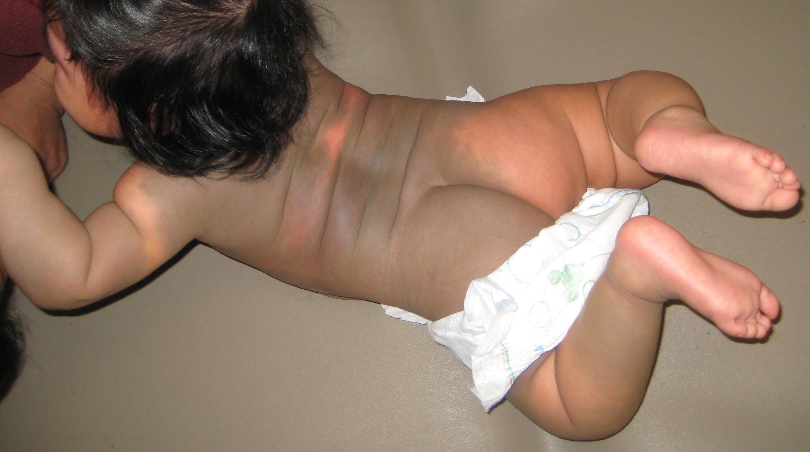 congenital dermal melanocytosis