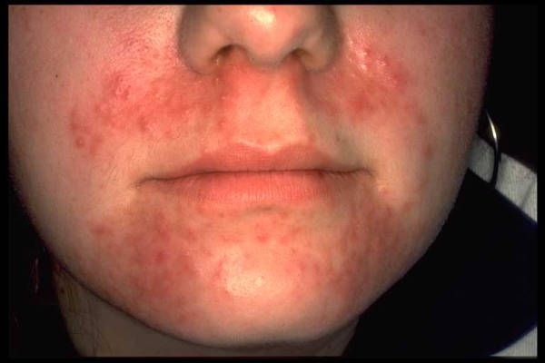 Perioral dermatitis in children. - ncbi.nlm.nih.gov