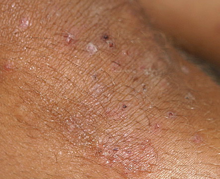 Dermatitis herpetiformis (ziekte van Duhring) - Huidziekten.nl