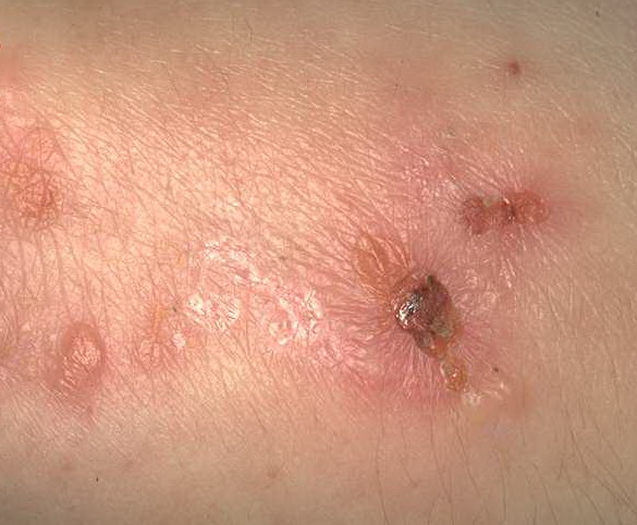 Dermatitis herpetiformis (ziekte van Duhring) - Huidziekten.nl
