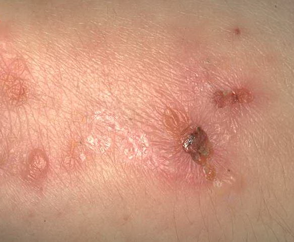 dermatitis herpetiformis (ziekte van Duhring) - heldere ...