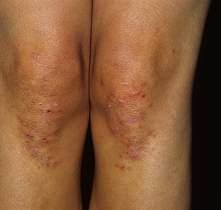 dermatitis herpetiformis pictures