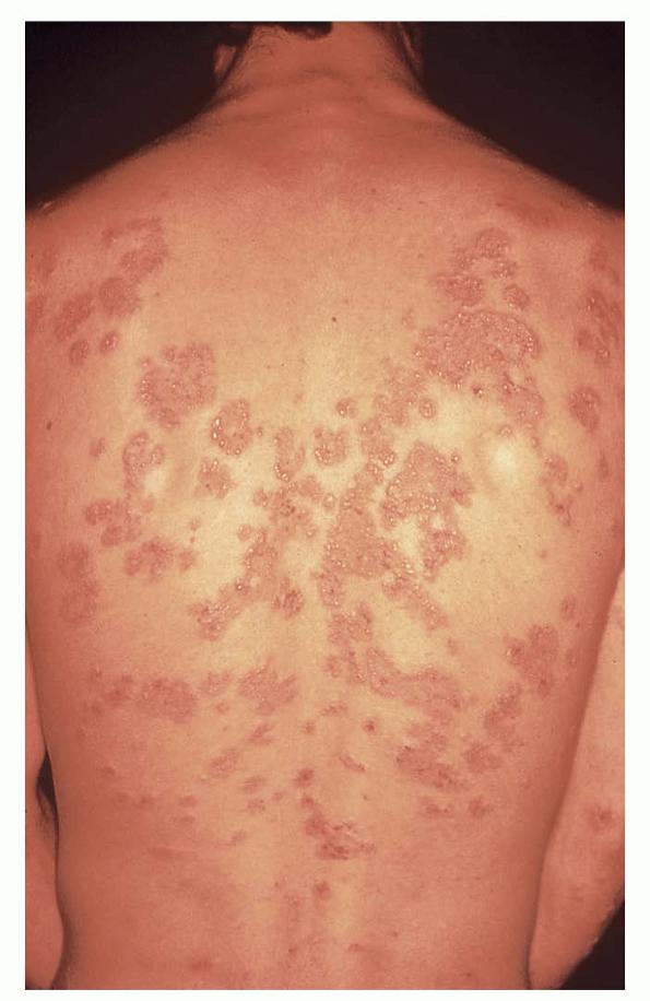 Dermatitis Herpetiformis - Celiac Disease Foundation