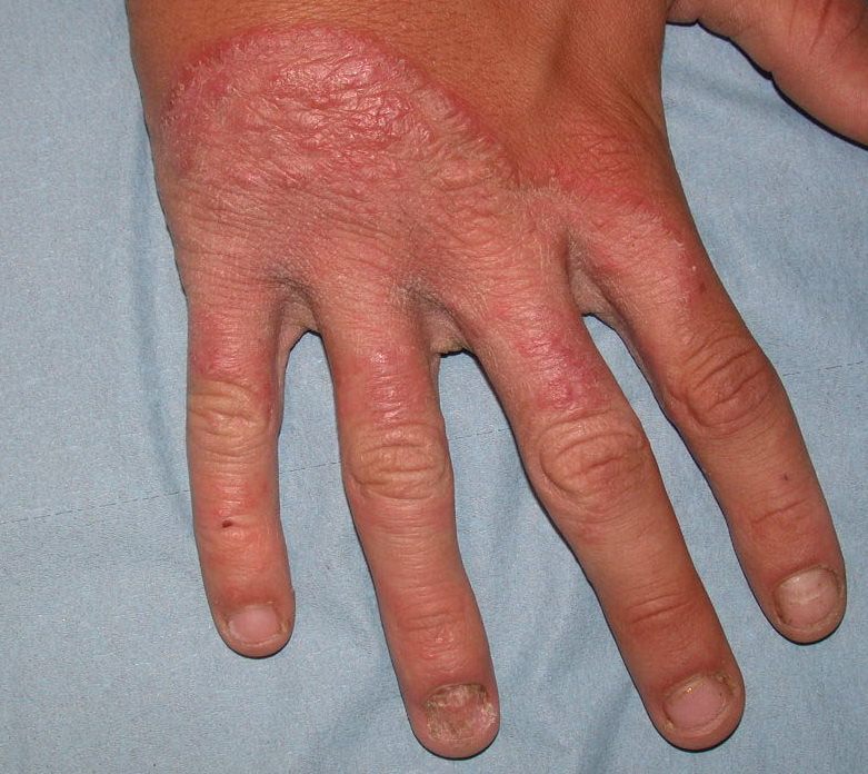 Dermatophytosis - Wikipedia