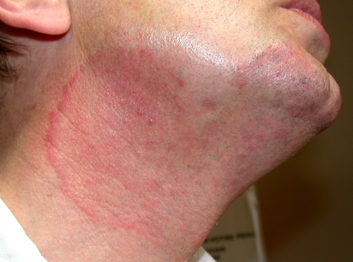 Dermatophytosis | Define Dermatophytosis at Dictionary.com