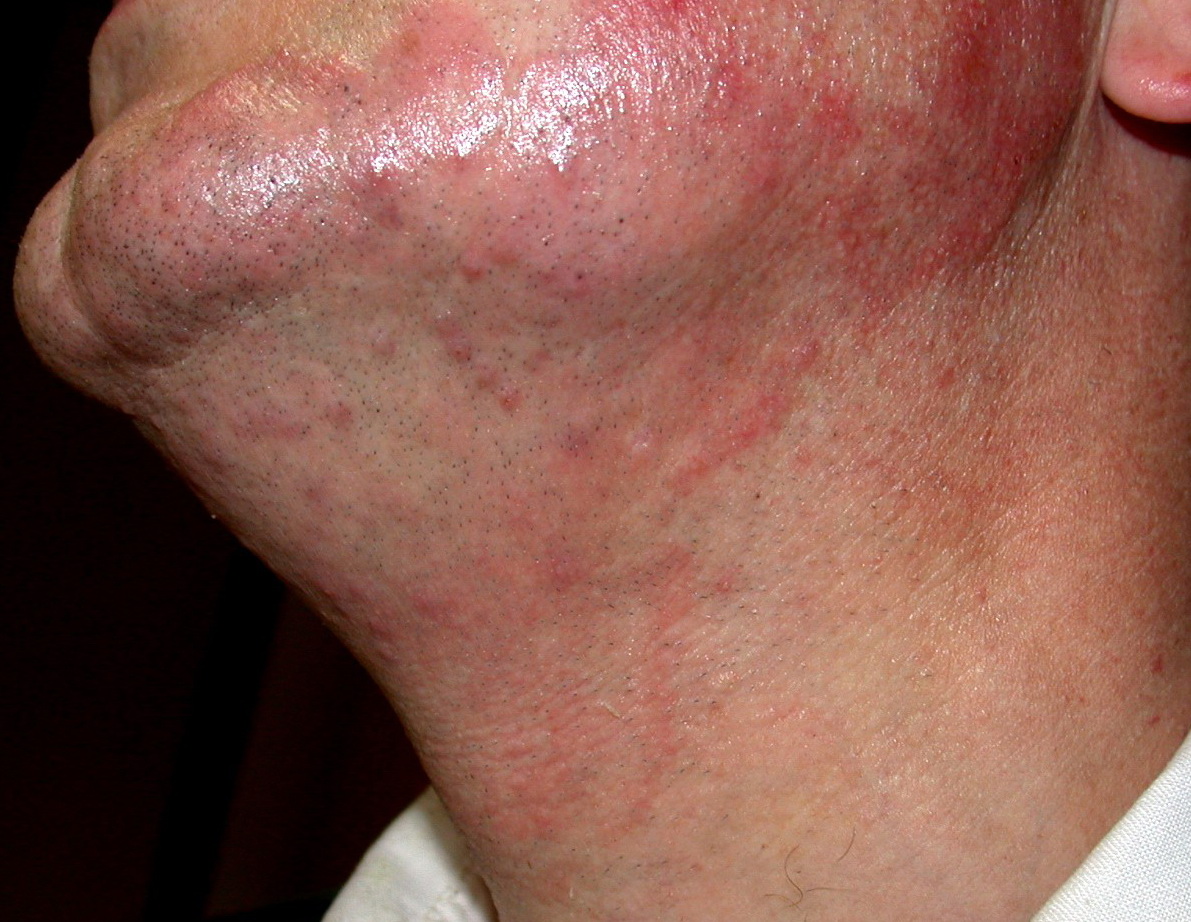 Dermatophyte (tinea) infections - UpToDate