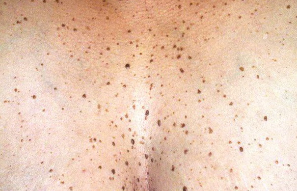 dermatosis papulosa nigra