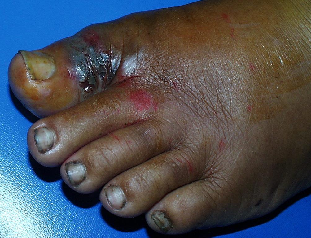 diabetic foot pain