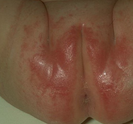 Candidiasis In Men. Known as painful illness thrush and how men has actually found Fills you may realize women
