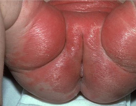 candida diaper dermatitis #11