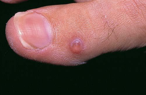 icd 10 code for myxoid cyst right toe