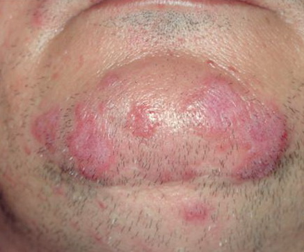 Lupus erythematodes - Wikipedia