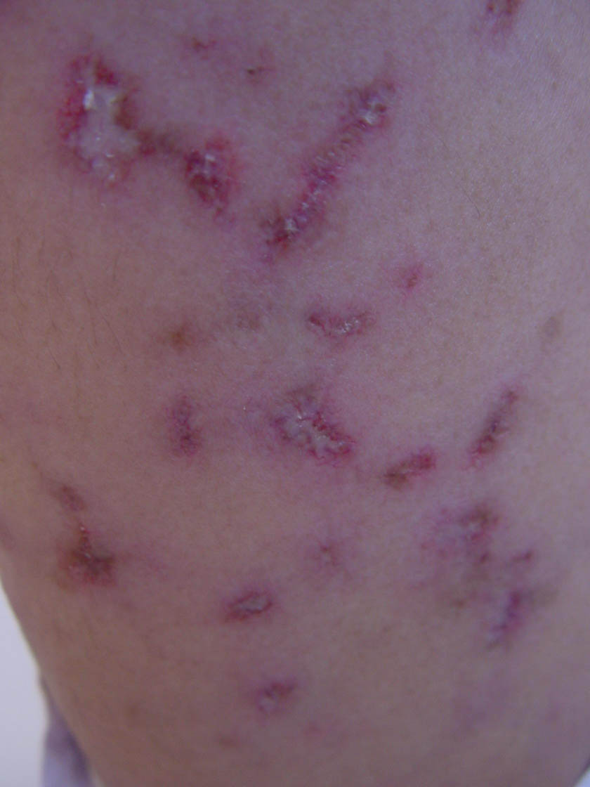 discoid lupus rash