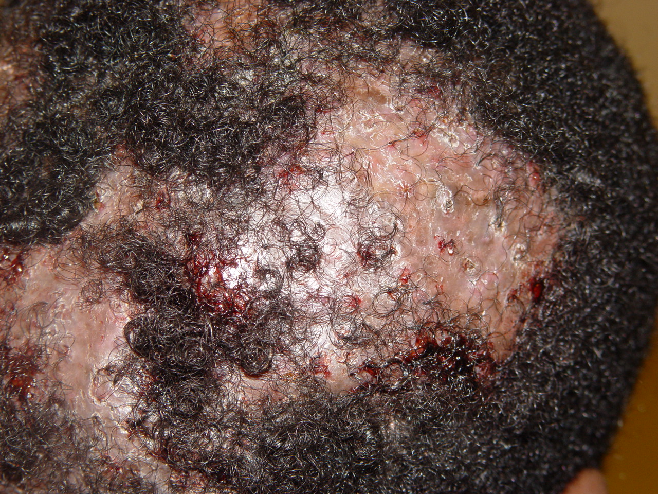 scalp cellulitis #10