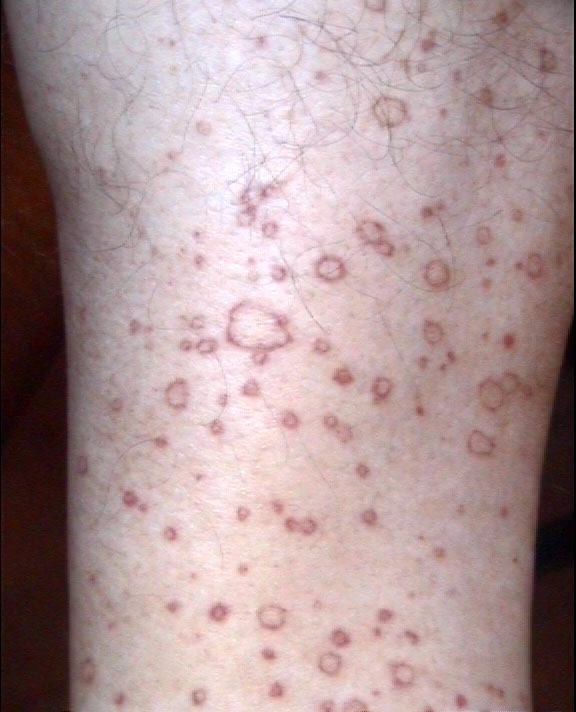 Corn Skin Disease