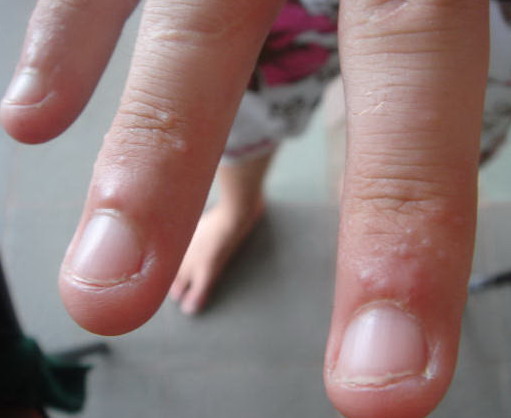 Hand Eczema | Eczema on Hands | National Eczema Association