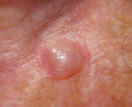 Syringoma - Wikipedia