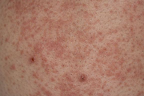 Chronic Eczema - Risks, Symptoms and Leading Causes | Treato