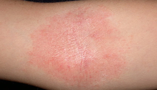 atopic dermatitis in adults