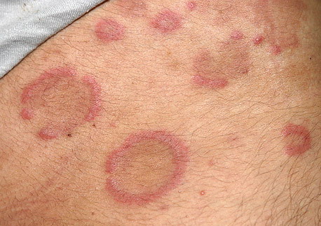 Erythema annulare centrifugum - Wikipedia