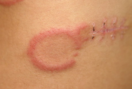 Erythema Annulare Centrifugum - Medscape Reference