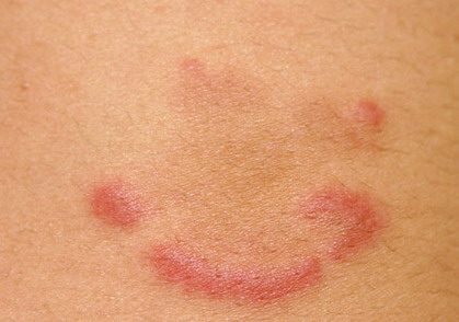 Eosinophilic annular erythema [eScholarship]