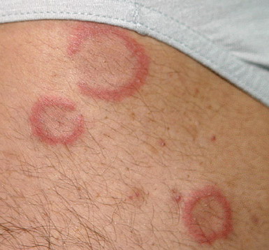 Rode ring op huid: erythema annulare centrifugum (EAC ...