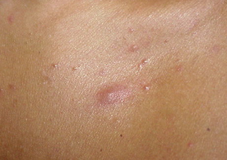 eosinophilic pustular folliculitis