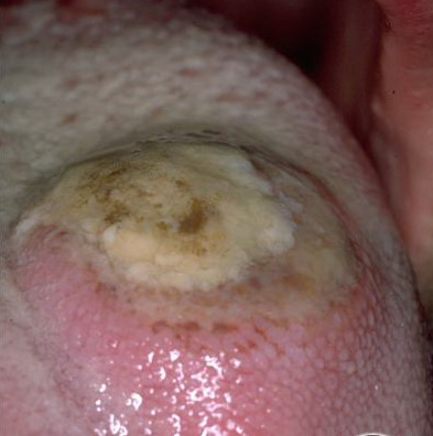 ulcers on tongue. Ulcer of the Tongueقرحة