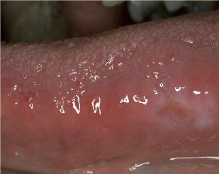 ulcers on tongue. Ulcer of the Tongue